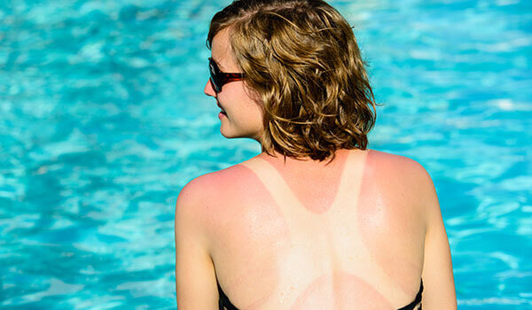 5 DOWNSIDES OF TANNING YOU DIDN’T KNOW ABOUT