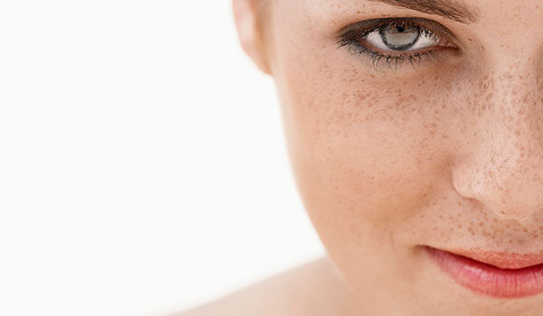 Everything you need to know about freckles